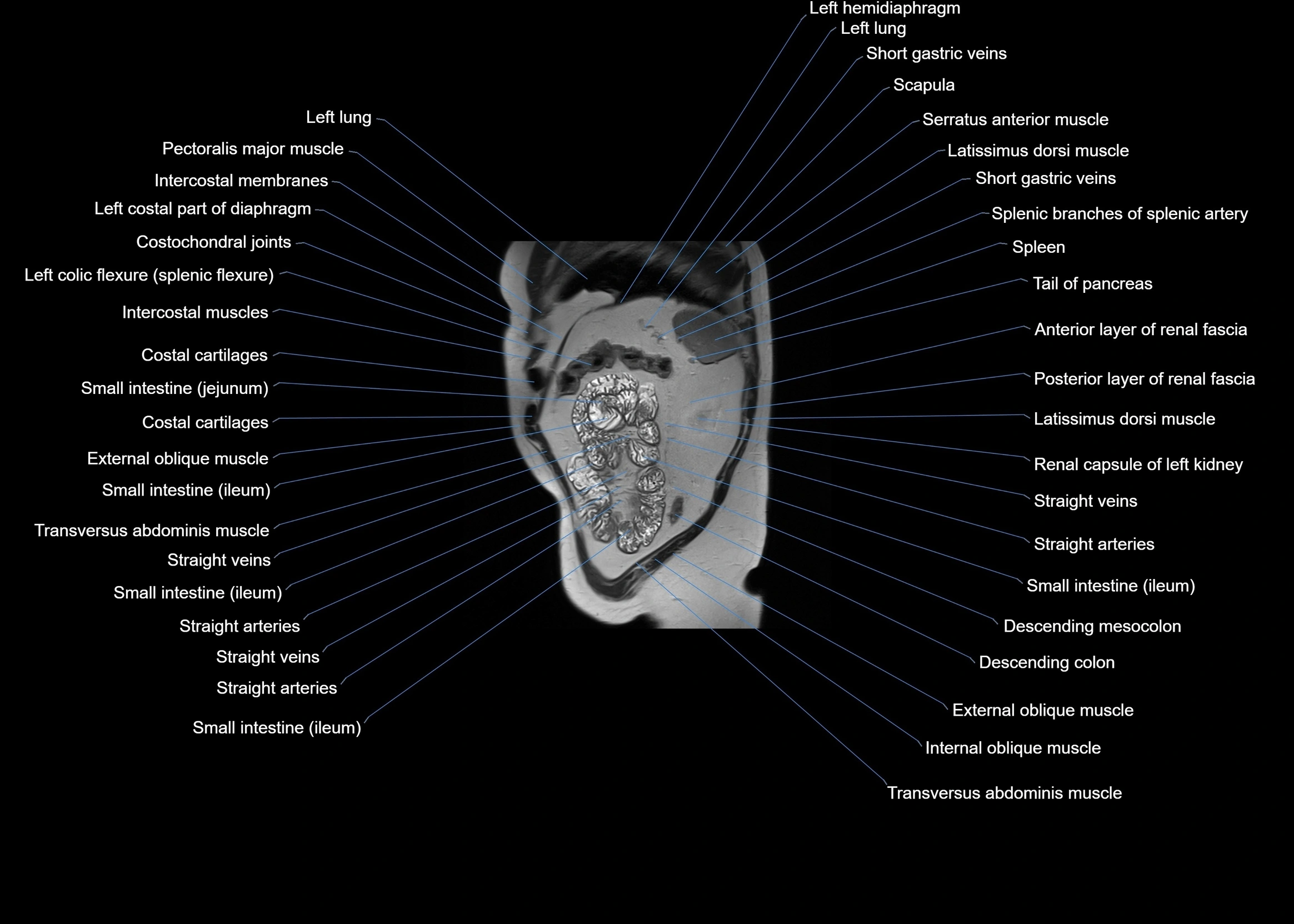 MRI abdomen sagittal cross sectional anatomy  radiology  image-img-00001-00058.webp